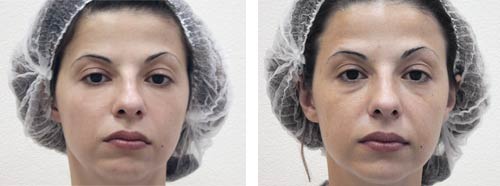 Photos Avant - Après d'un traitement du tiers-inférieur du visage par des injections d'acide hyualuronique à Paris