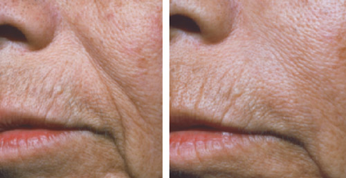 L'acide hyaluronique permet de combler les rides du visage tel que les sillons naso-géniens
