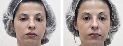 Photos avant - après d'un traitement du tiers-inférieur du visage par des injections d'acide hyaluronique à Paris
