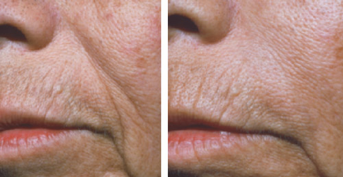 L'acide hyaluronique permet de combler les rides du visages tel que les sillons naso-géniens