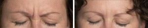 Photo avant - après d'une injection de botox