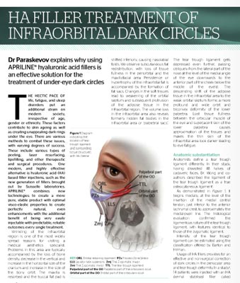 Traitement des cernes par injection d’acide hyaluronique