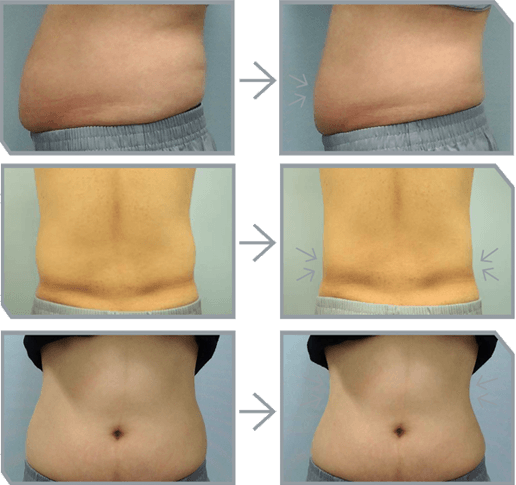 Résultats avant - après de la cryolipolyse Micool