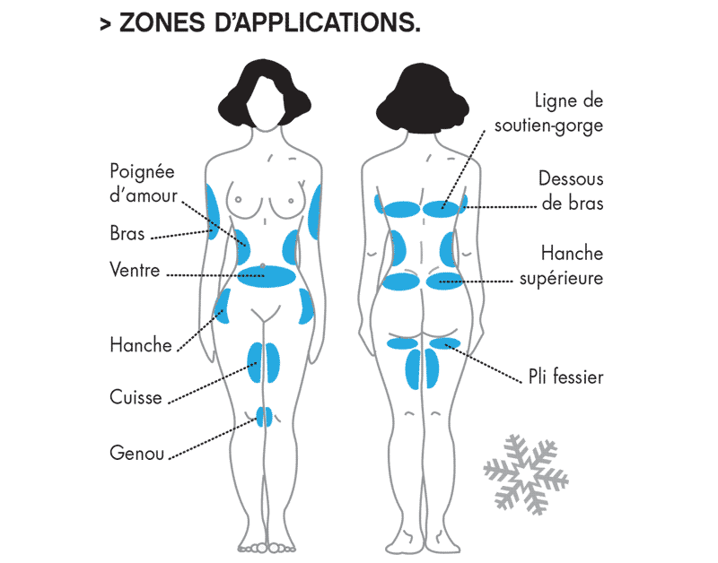 Zones du corps traité par cryolipolyse micool : ventres, abdomen, poignet d'amour, cuisses