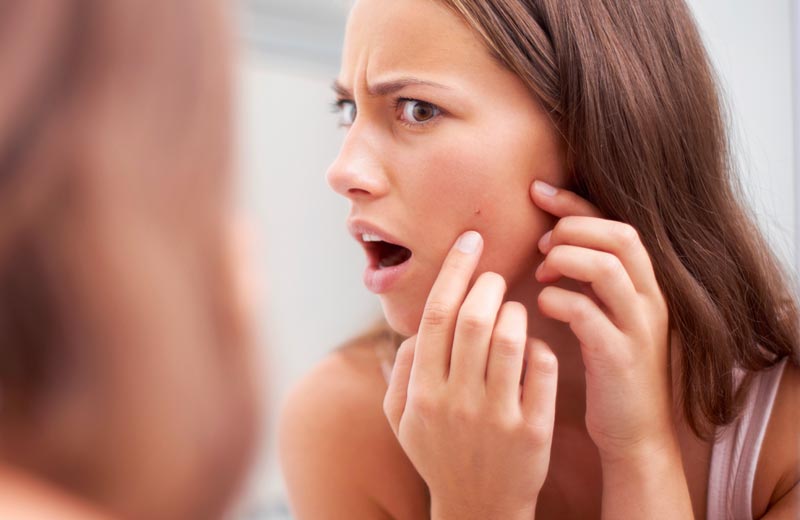Supprimer les cicatrices d'acné un peeling du visage