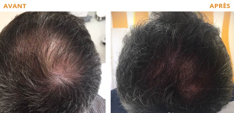 Photo avant - après d'un traitement de la chute des cheveux par PRP (Plasma Riche en plaquette