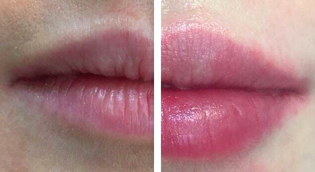 Photo avant - après du résultat d'une augmentation du volume des lèvres par injection d'acide hyaluronique