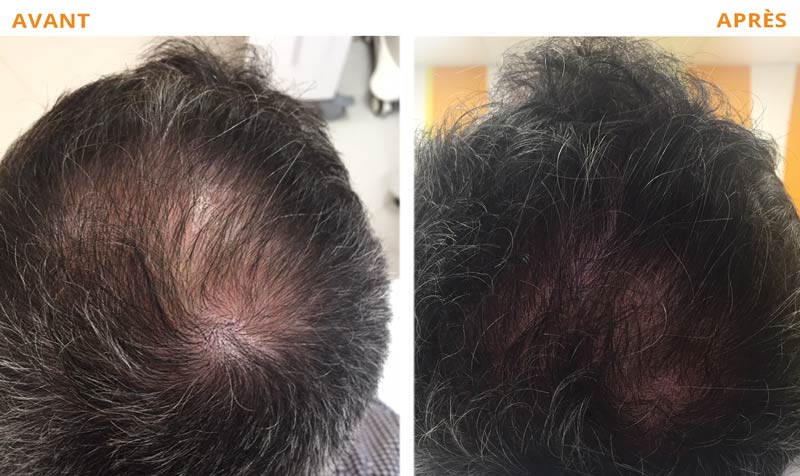 Photo avant - après d'un traitement de la calvitie avec le PRP Cheveux