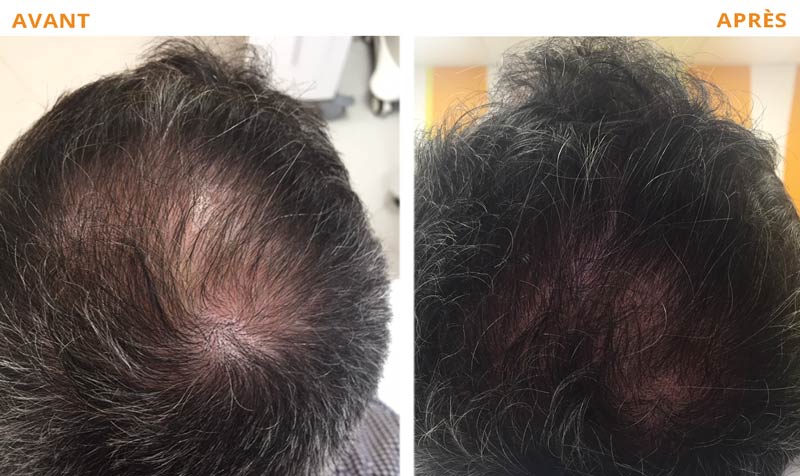 Photo avant - après d'un traitement de la calvitie avec le PRP Cheveux