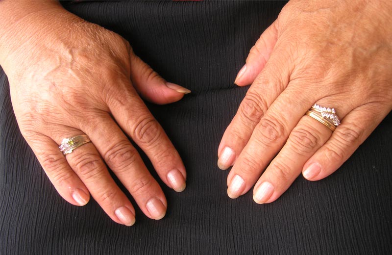 Traitements esthétiques des mains à l'acide hyaluronique 